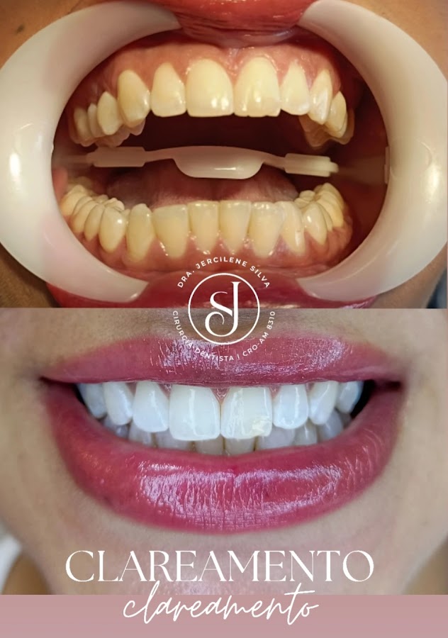 Resultado de clareamento dental — antes e depois