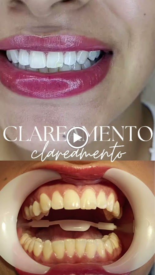 Clareamento dental — resultado clínico 2