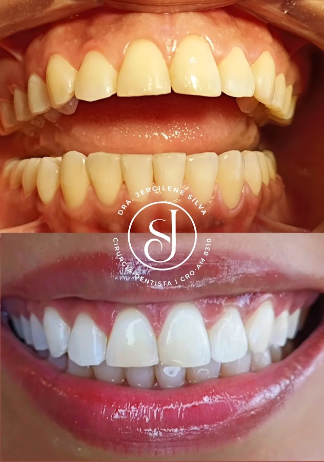 Clareamento dental — resultado clínico 3